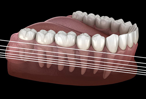 A 3-dimensional diagram illustrating the monthly shrinkage of bone after tooth extraction