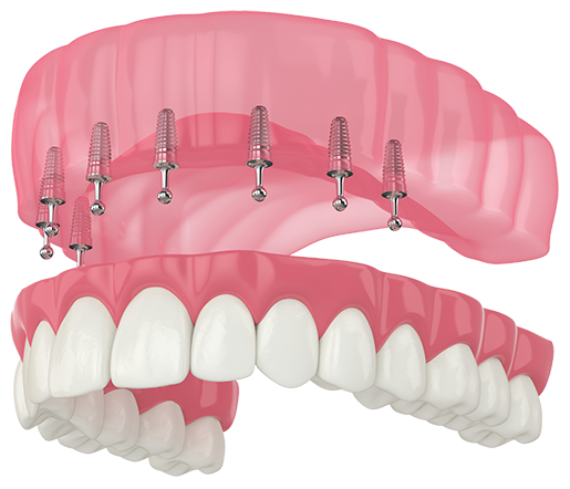 A 3-dimensional diagram of an removable upper denture below implants in the upper jaw